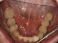 Final Lower Restorations