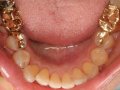 Gold Restoration Lower  1600x1200  opt