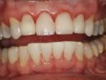 post tx bleaching  1600x1200  opt