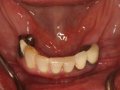pre implant  1600x1200  opt