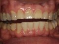 pre tx bleaching  1600x1200  opt