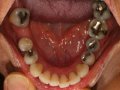 pre tx resin fillings  1600x1200  opt