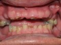 pre tx worn teeth  1600x1200  opt